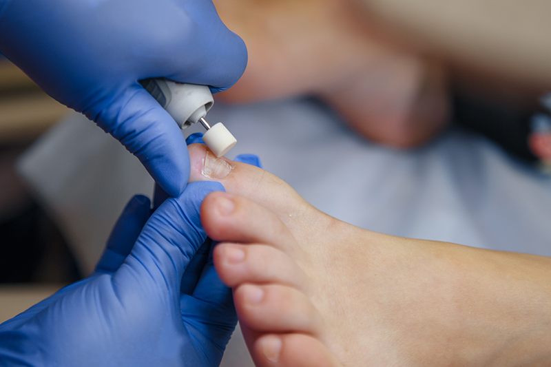 Why Podiatrists Grind Toenails