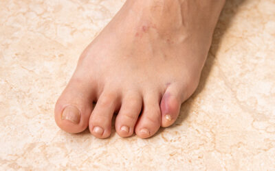 Stubbed Toe: A Common Injury In Households