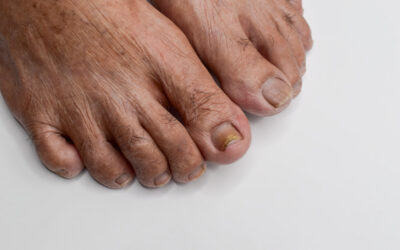 Why Do Toenails Thicken In The Elderly?